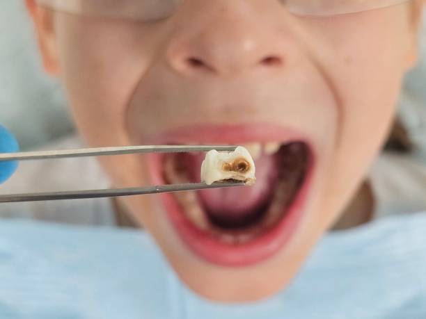 Best Emergency Dental Extractions in Clark Mills, NY